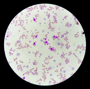Photomicrograph of hematological slide showing severe anemia. Hemolytic anemia, iron deficiency anemia.
