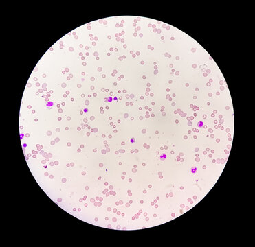 Photomicrograph of hematological slide showing severe anemia. Hemolytic anemia, iron deficiency anemia.