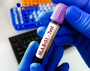 Blood sample for HLA B51 (human leukocyte antigen). to diagnose Behcet's disease (BD)