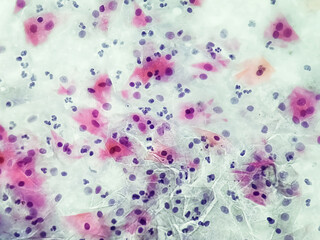 Gardnerella vaginalis infection pap smear under microscopy.
