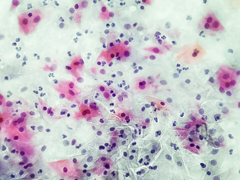 Gardnerella vaginalis infection pap smear under microscopy.