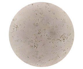 Asthenozoospermia, a common cause of human male infertility characterized by reduced sperm motility