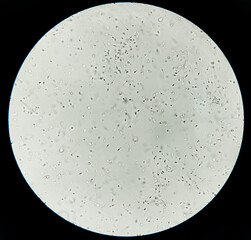 Asthenozoospermia, a common cause of human male infertility characterized by reduced sperm motility