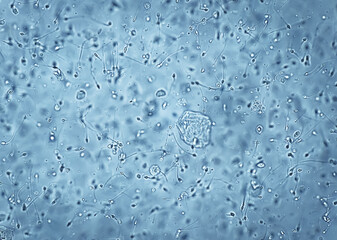 Asthenozoospermia, a common cause of human male infertility characterized by reduced sperm motility