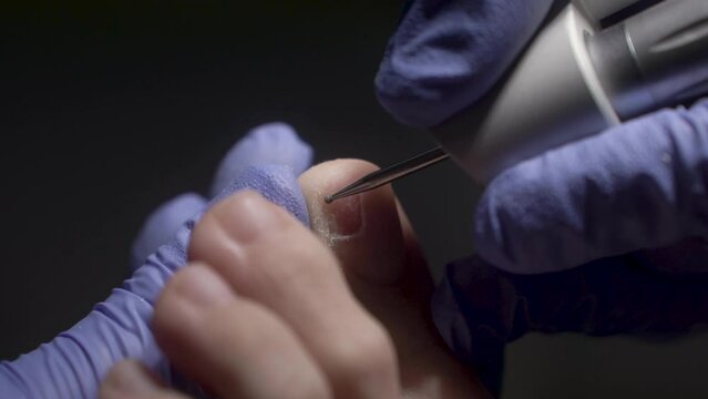 The podologist scrapes the nail with a buffing attachment