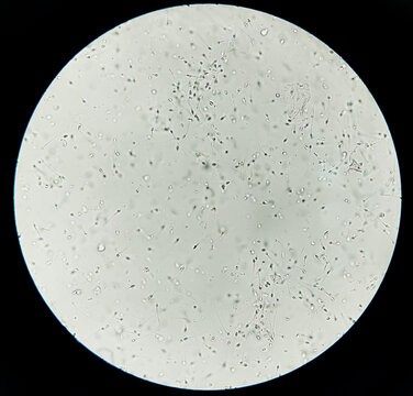 Asthenozoospermia, a common cause of human male infertility characterized by reduced sperm motility