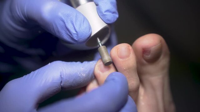 Podologist polishes the toe cuticle toe fingers with a mechanical device 