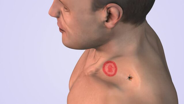 Lyme disease with tick on shoulder neck medical concept