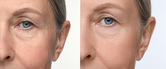 Aging skin changes. Collage with photos of mature woman before and after cosmetic procedure on white background, closeup
