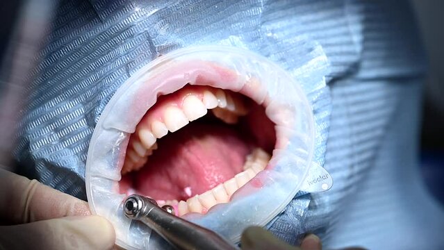 A dentist is seen brushing a womans teeth during a routine dental check-up. The dentist carefully cleans the teeth using a professional toothbrush and dental tools