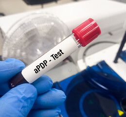 Blood sample for aPDP (Activated Human Cord Blood Platelet- Depleted Plasma) test,