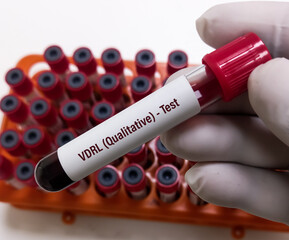 Blood sample for VDRL(Qualitative), RPR test, Syphilis screening test. To diagnosis Syphilis and...