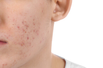 Fototapeta premium Young man with acne problem isolated on white, closeup