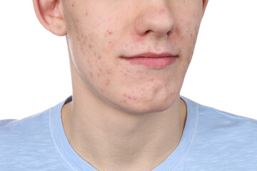 Obraz premium Young man with acne problem isolated on white, closeup