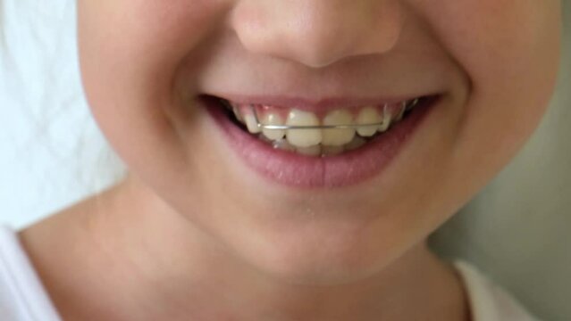 Kid girl mouth with orthodontic plate closeup. Teeth alignment, retainer orthodontic correction. Removable plates and simple treatment