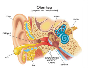 Medical illustration of some symptoms and complications of otorrhea, a pathology that affects the ear, with annotations.