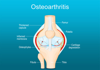 Osteoarthritis. Arthritis of a knee joint - obrazy, fototapety, plakaty
