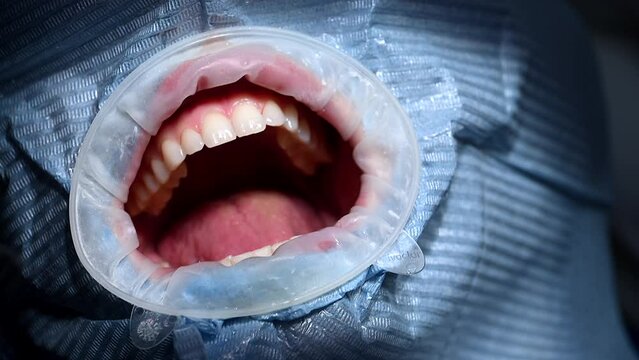 Open Mouth Inside Plastic Bag