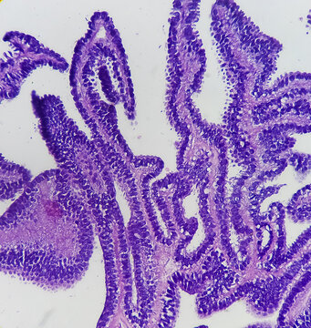 Microscopic image of Papillary borderline serous tumor of the ovary (low malignant potential) with branching papillae lined by stratified cells with nuclear atypia. Ovarian serous borderline tumors.