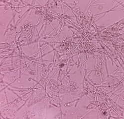 Pseudo hyphae and budding yeast cells in patient urine (urinary tract infections), photomicrograph...