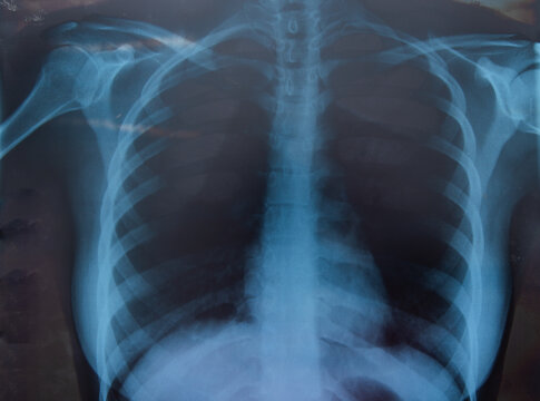 Woman xray for chest and lungs examination