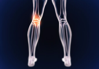 Legs, skeleton and red pain with graphic for xray, exam and analysis in healthcare overlay and dark or black background. 3D of anatomy, radiology and knee or joint illustration for injury and physio