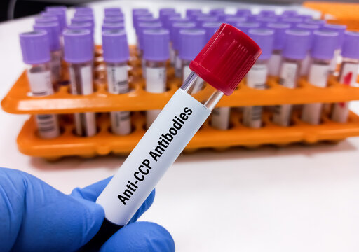 Blood sample tube for Cyclic citrullinated peptide antibody(anti-CCP) test, diagnosis for rheumatoid arthritis disease.