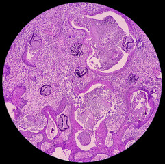Nasal mass biopsy: Rhinosporidiosis, microscopic show large thick walled sporangia with many endospores accompanied by a mixed inflammatory infiltrate. - obrazy, fototapety, plakaty