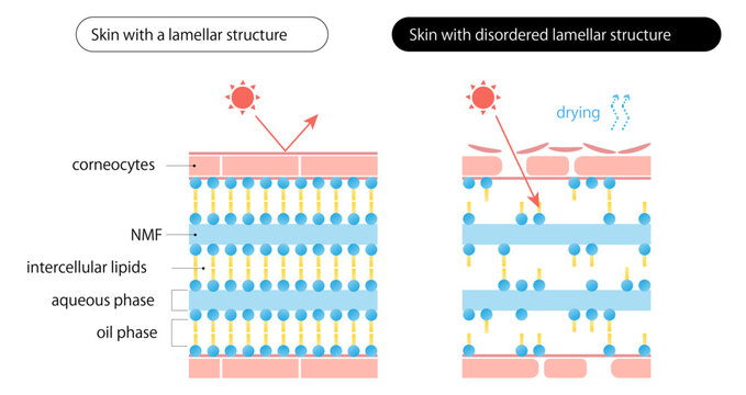 ラメラ構造が乱れた肌_Skin with disordered lamellar structure