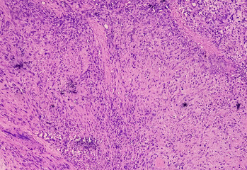 Bone cancer. Chondroblastic osteosarcoma. It's very rare cancer, microscopically show atypical...