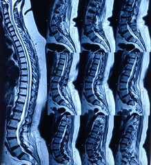 MRI scan of sacro-lumbar spines of a patient with chronic back pain and weakness of leg. The MRI...