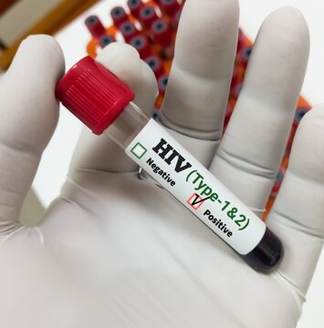 Blood sample in a test tube with label HIV (Type 1 and 2) test. HIV positive sample. Sexual transmitted disease.