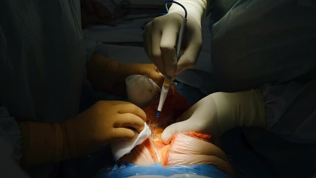 The doctor makes an incision with a scalpel on the abdomen. Plastic surgery operation. 