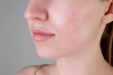 Young woman with acne problem on light grey background, closeup