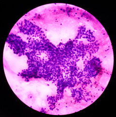Parotid swelling cytology, Monomorphic adenoma. Smear show cellular material of epithelial cells in clusters and singly on the background of blood.