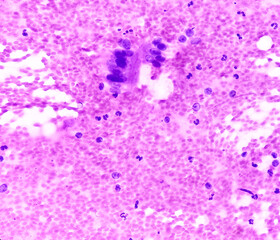 CT guided FNA from lung lesion, Chronic granulomatous inflammation (CGI) with Tuberculosis. CGI-TB....