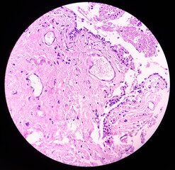 Urachal cyst or Urethral cyst (biopsy). Microscopically show cyst wall of fibrocollagenous tissue lined by transitional epithelium. Skene gland cysts.