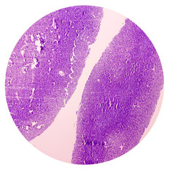 Soft tissue sarcoma, plasmacytoma, undifferentiated pleomorphic sarcoma. Microscopically show...