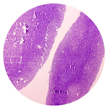Soft tissue sarcoma, plasmacytoma, undifferentiated pleomorphic sarcoma. Microscopically show malignant neoplasm of atypical plasmacytoid cells. plasma cell tumor.