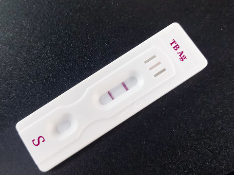 Rapid test device or kit for Tuberculosis (TB) test. ICT for TB. show positive result. Tuberculosis antigen test.