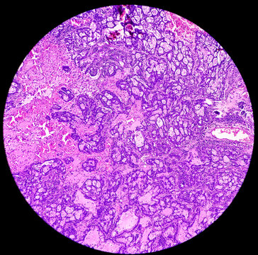 Lung cancer - adenocarcinoma, mucinous type. Therapies for specific genetic mutations (biomarkers EGFR, ALK, ROS1, BRAF, PDL1, KRAS) are appropriate for selected cases.
