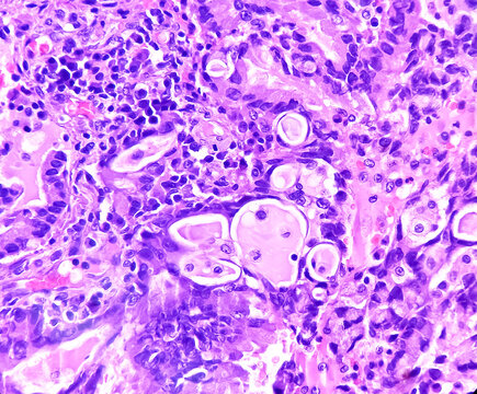 Lung cancer - adenocarcinoma, mucinous type. Therapies for specific genetic mutations (biomarkers EGFR, ALK, ROS1, BRAF, PDL1, KRAS) are appropriate for selected cases.
