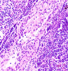 Lung cancer - adenocarcinoma, reactive change, lymph node show fibro collagenous tissue and neural tissue. - obrazy, fototapety, plakaty