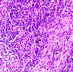Lung cancer - adenocarcinoma, reactive change, lymph node show fibro collagenous tissue and neural tissue. - obrazy, fototapety, plakaty