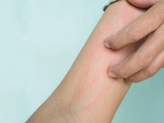 Hand with Urticaria Allergy Itchy Rash Eczema Itch Woman from Food,Air...