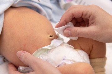 Cleaning newborn baby umbilical cord, treat the navel to a newborn baby , first week of life.