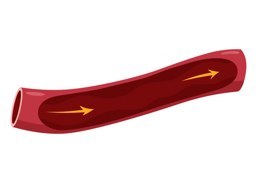 Atherosclerosis stage. Anatomy of heart attack. Arteriosclerotic vascular disease or ASVD. Atherosclerotic plaque in coronary artery. Vector illustration on white background