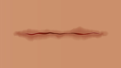 Healing wounds, skin scar, stitched gash and cut. Realistic surgical suture, stitched wounds. Healing stage on human skin background. Vector illustration