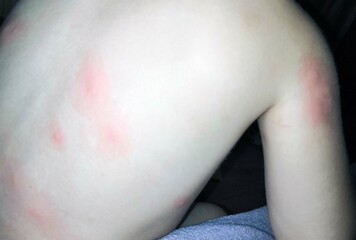 A shirtless child with red bite marks on his back