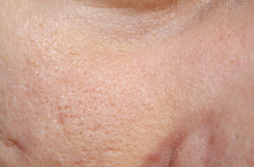 Enlarged pores on the face and acne scars. Dermatology stock photos in the best quality.